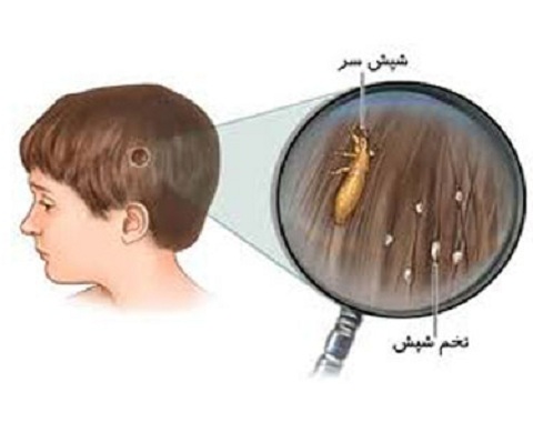 درمان سریع و قطعی شپش موی سر
